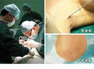 狐臭的比较佳治疗方法 手术过程.jpg